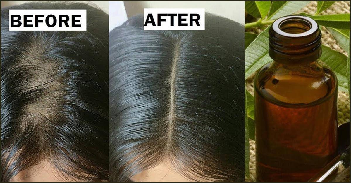 How To Get Rid Of Lice Fast12 Easy Remedies And OTC Medications SLECK