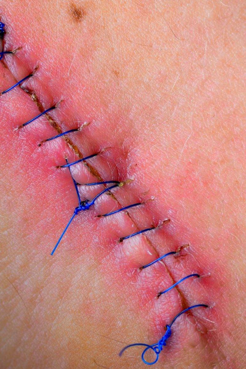how to remove stitches