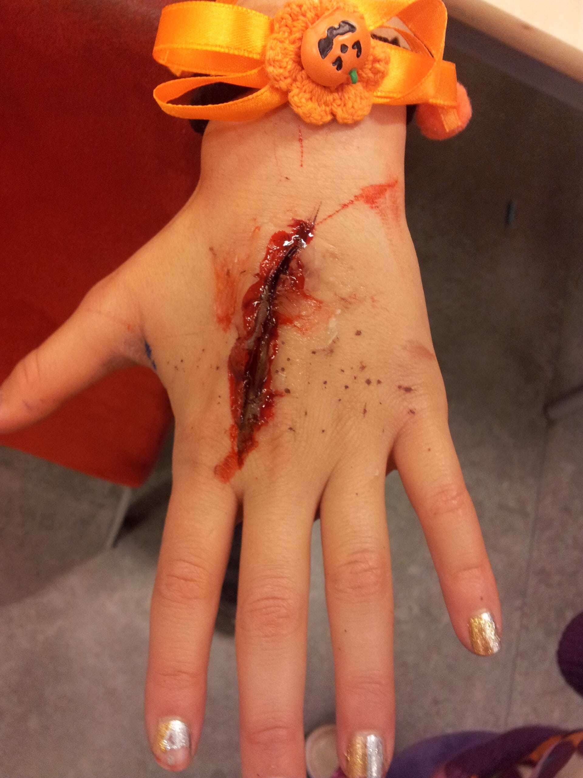 when to get stitches hand, wound, blood